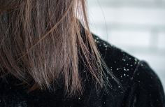 Best Dandruff Treatments, Dandruff